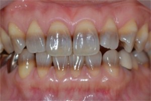 Tetracycline-stains-pick